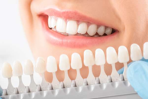 The Process Of Getting Dental Veneers: What To Expect