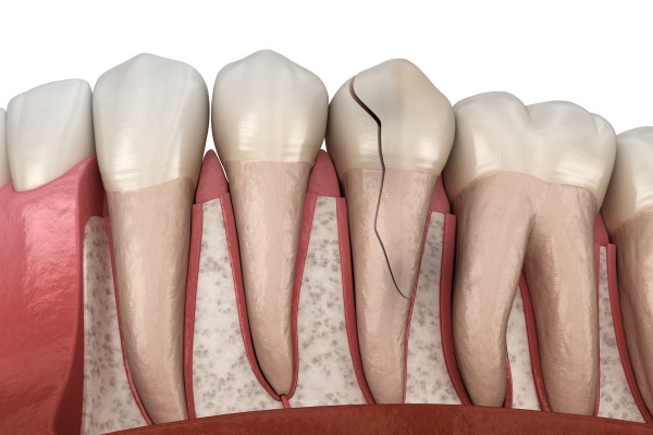 Chipped & Broken Denture Tooth Repair